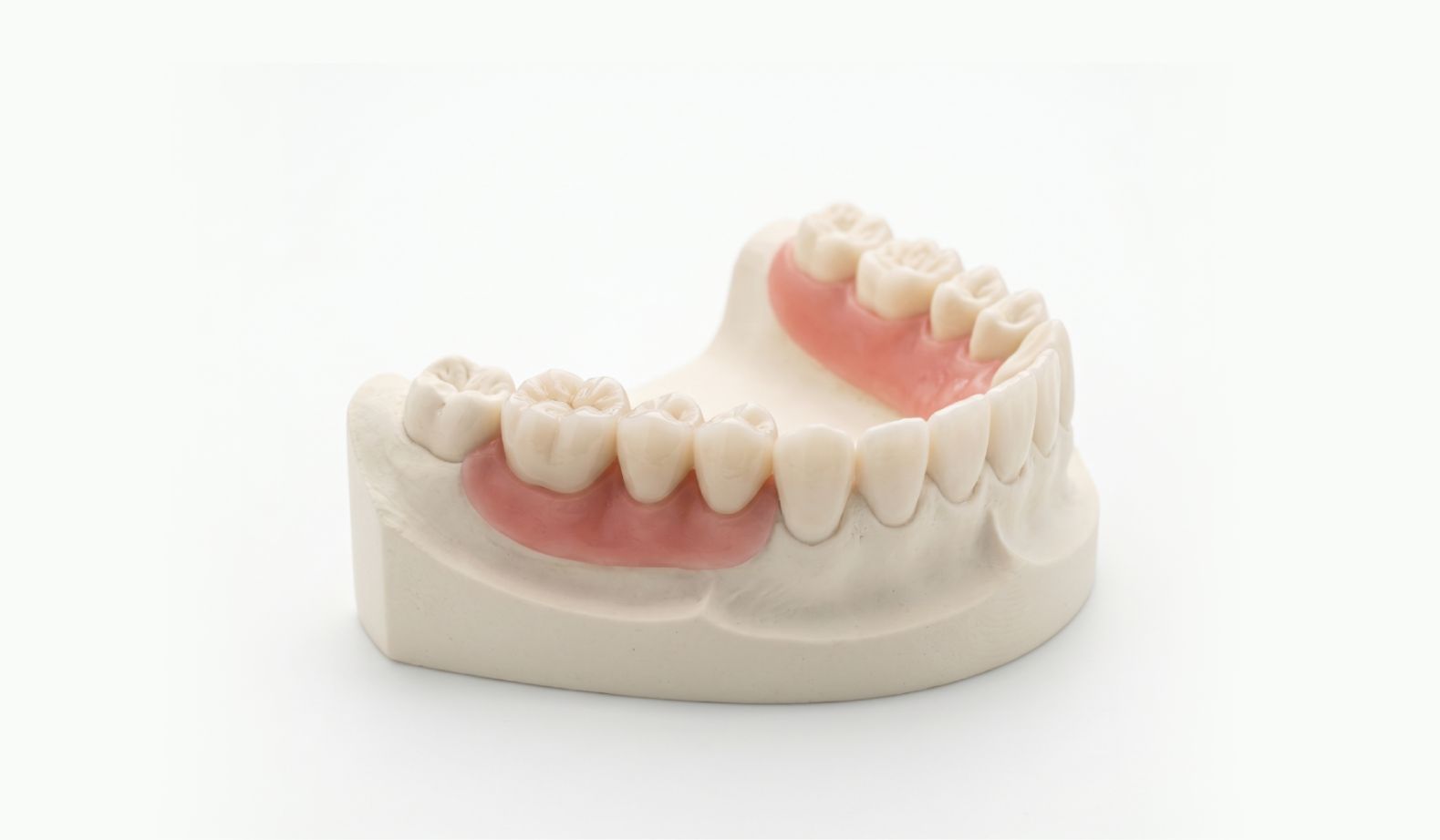 Dental crowns and bridges in Kochi to restore damaged teeth