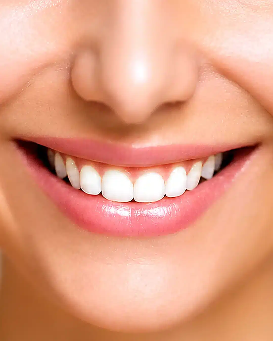 Teeth Whitening and Smile Makeover in Kochi Professional teeth whitening and smile makeover result at Mazhuvenchery dental clinic in Kochi showing bright natural white smile